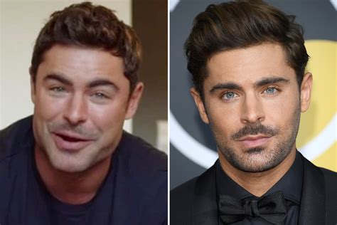 zac efron after jaw surgery.